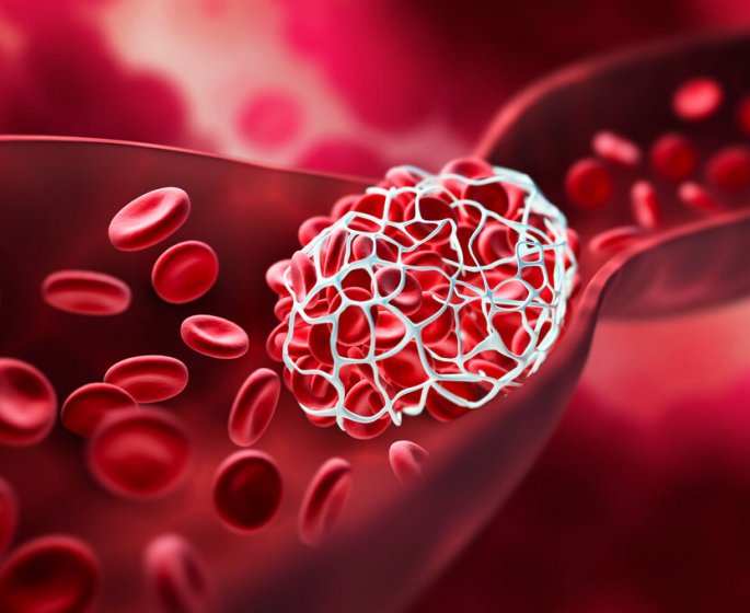 Caillot sanguin : 5 signes qui doivent vous pousser a consulter
