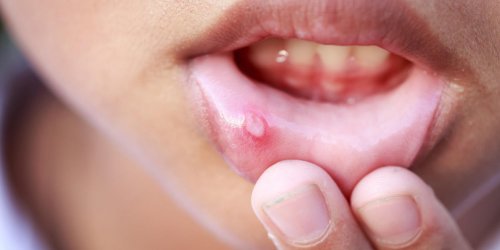 Aphte langue, bouche, gencive, levre… : symptomes, causes et traitements
