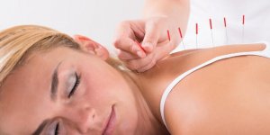 Sciatique : l-acupuncture pour eviter la recidive ?