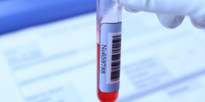 Taux d’immunoglobuline : l’anomalie du sang qui peut evoluer en cancer