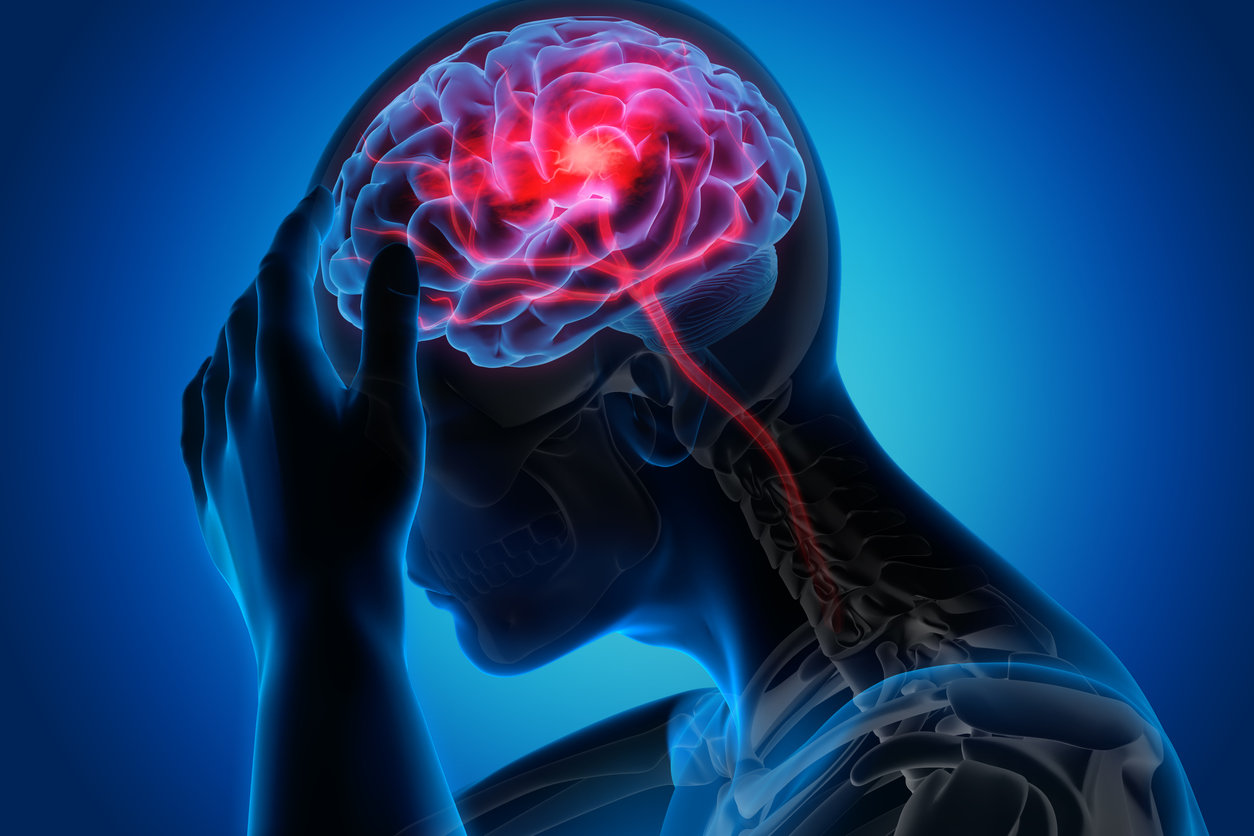Accident Vasculaire Cérébral Avc Symptômes Définition Signes Causes Traitements