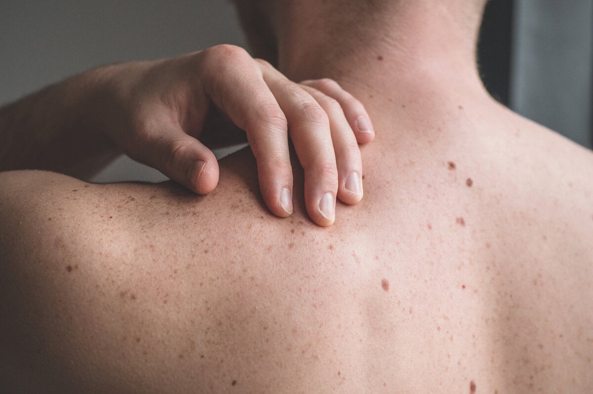 These signs on your skin can indicate heart disease