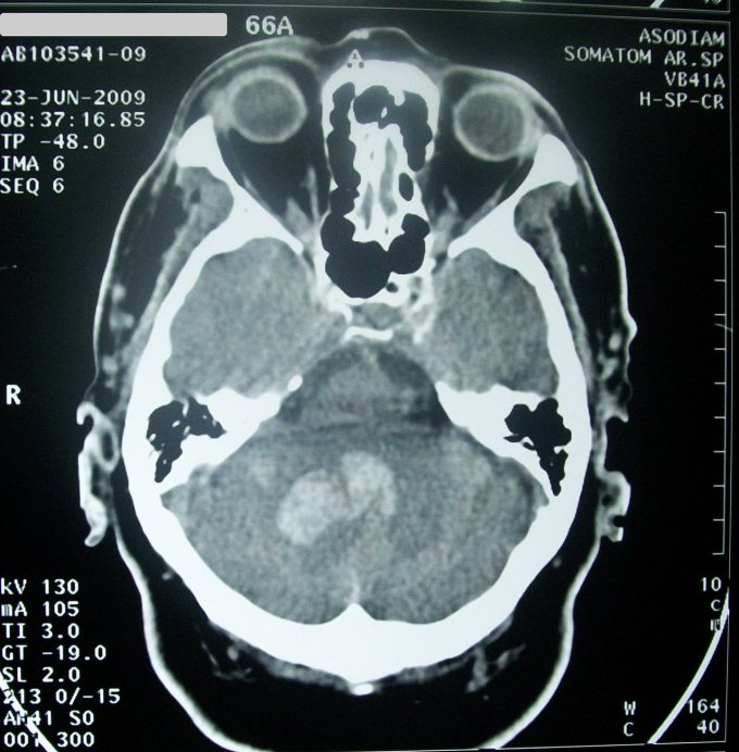 Photo : scanner cérébral montrant une hémorragie profonde due à un saignement