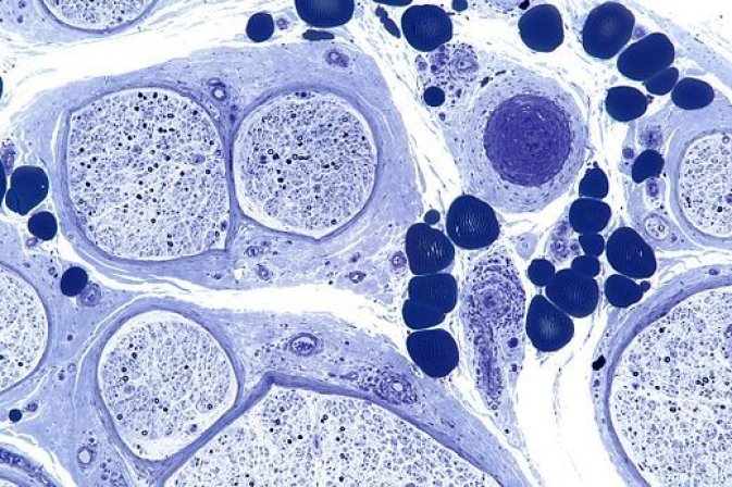 Photo : coupe histologique (des tissus) révélant une neuropathie périphérique secondaire à une vascularite (inflammation des parois des vaisseaux sanguins)