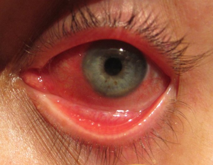 Allergies oculaires: Conjonctivite et réaction allergique