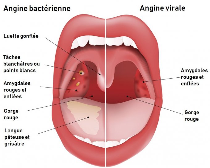 Test pour distinguer les angines virales des angines bactériennes -  Doctissimo