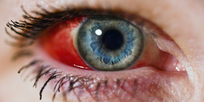 11 Maladies Qui Donnent Les Yeux Rouges