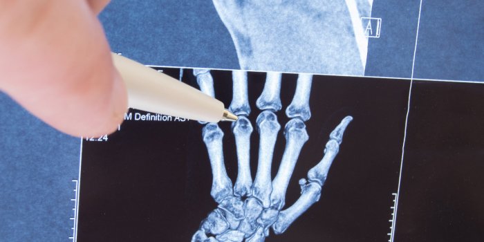 8-Radiographies de lindex et du majeur dune main droite