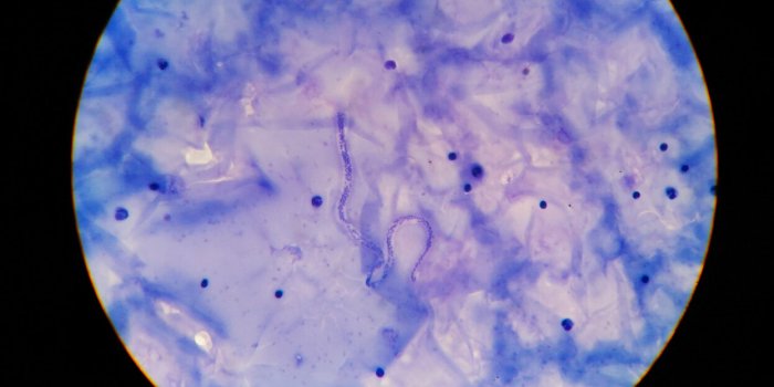microfilaria tissue parasite infection to human in parasitology