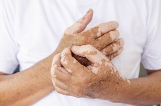 Depigmentation de la peau et des poils : le point sur les traitements a venir contre le vitiligo
