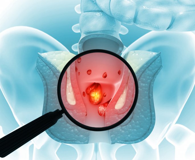 Hemorroides : cette nouvelle technique (remboursee) les elimine sans douleurs