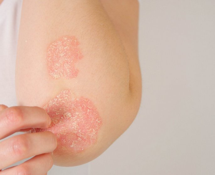 Les chercheurs francais decouvrent que le fer serait une nouvelle voie de traitement pour le psoriasis