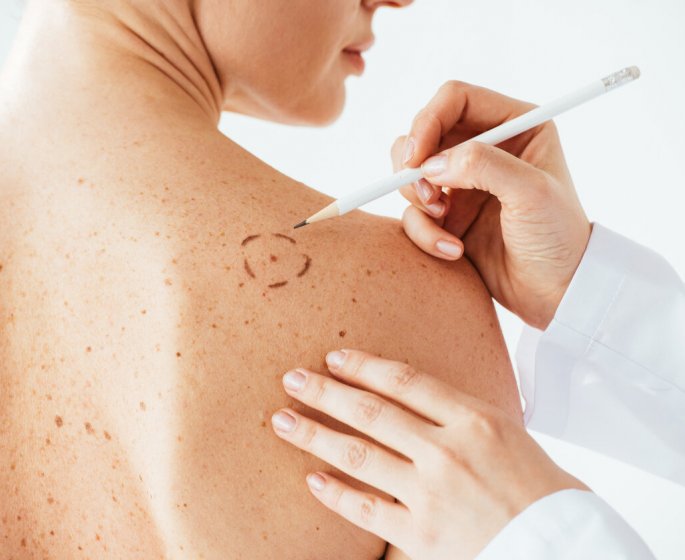 Cancer de la peau : comment le distinguer d-une eruption cutanee