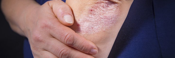 Psoriasis des coudes et genoux que faire