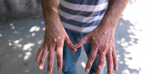 Variole du singe - mpox : l’OMS alerte l’Europe sur les risques apres un premier cas detecte en Suede