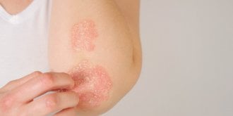 Les chercheurs francais decouvrent que le fer serait une nouvelle voie de traitement pour le psoriasis