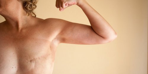 Cancer du sein : Decathlon sort une brassière de sport post-mastectomie