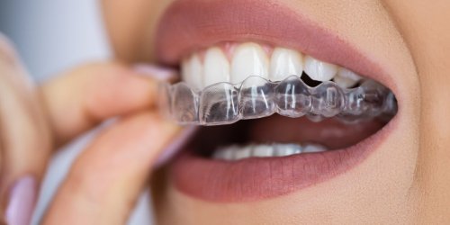 Eclaircissement dentaire : ce qu’il faut savoir sur ce &quot;lifting des dents&quot;