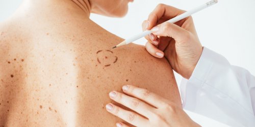 Cancer de la peau : comment le distinguer d-une eruption cutanee