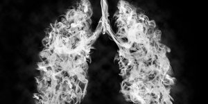 Cancer du poumon : ces nouveaux traitements tres prometteurs 