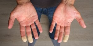 Vous avez souvent les mains froides ? Faites le test pour savoir si c’est la maladie de Raynaud