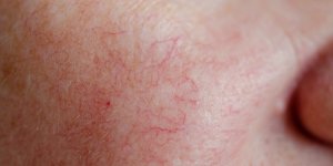 7 causes probables de la couperose sur votre visage