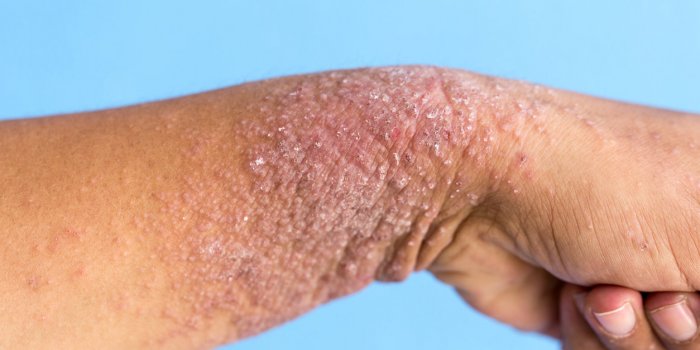 Dermatite atopique : comment la reconnaître pour mieux la traiter