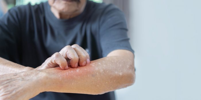 cropped image of asian elder man scratching his forearm concept of itchy skin diseases such as scabies, fungal infection ...