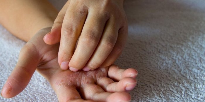 Le psoriasis lié a un risque de maladies cardiovasculaires ?