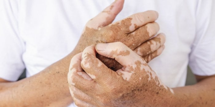 Dépigmentation de la peau et des poils : le point sur les traitements à venir contre le vitiligo