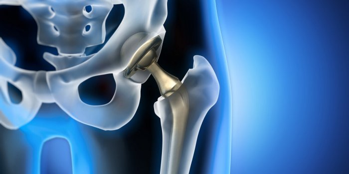 3d rendering of total hip replacement - medical illustration