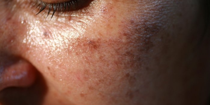 pigmented spots on the face pigmentation on cheeks