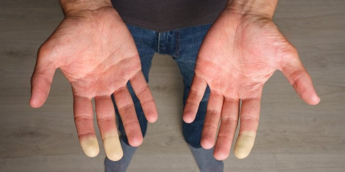 Vous avez souvent les mains froides ? Faites le test pour savoir si c’est la maladie de Raynaud