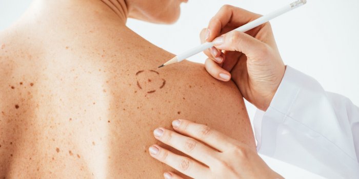 Cancer de la peau : comment le distinguer d'une éruption cutanée