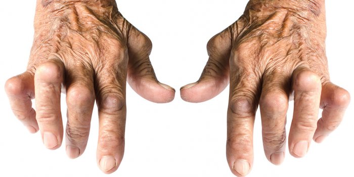 Polyarthrite rhumatoide : les sept gestes a faire pour limiter la douleur